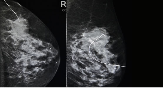 needle localization breast Asian morning glory